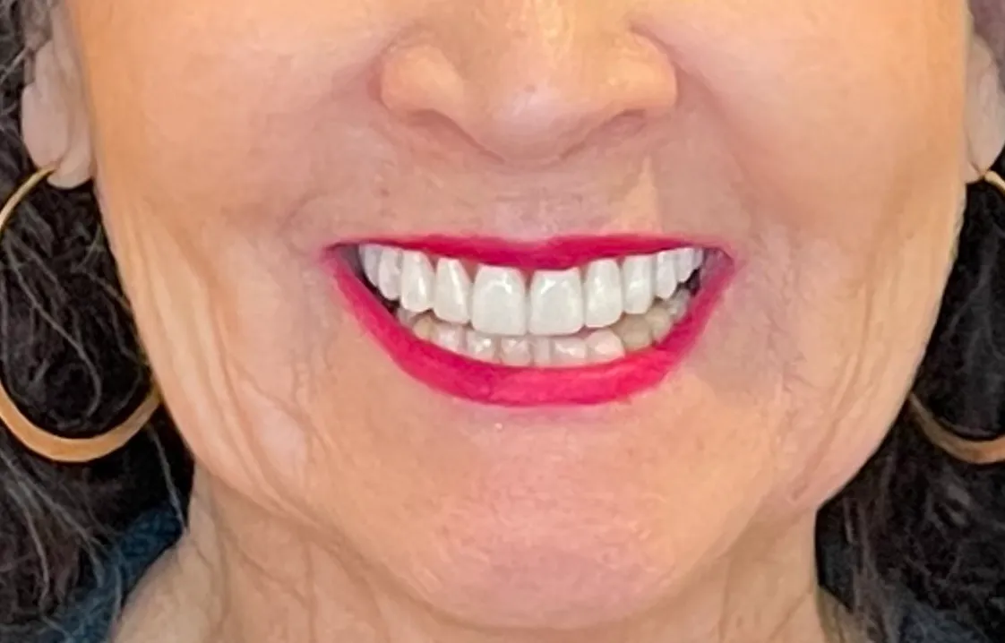 AOX Smile: After