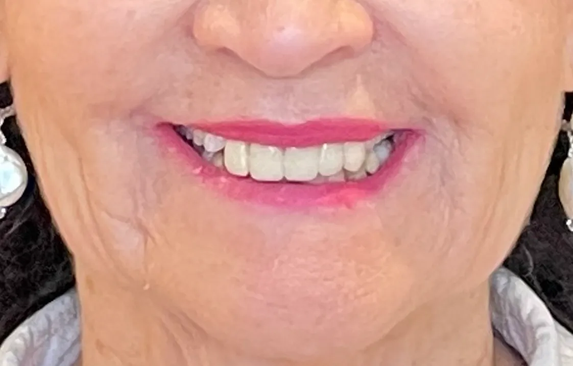 AOX Smile: Before