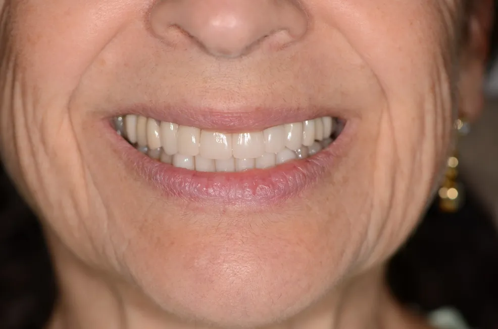 Porcelain Veneers and Bioclear Lower Front teeth: After