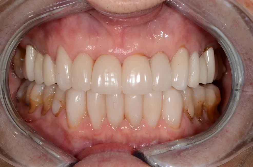 Porcelain Veneers and Bioclear Lower Front teeth: After Closeup