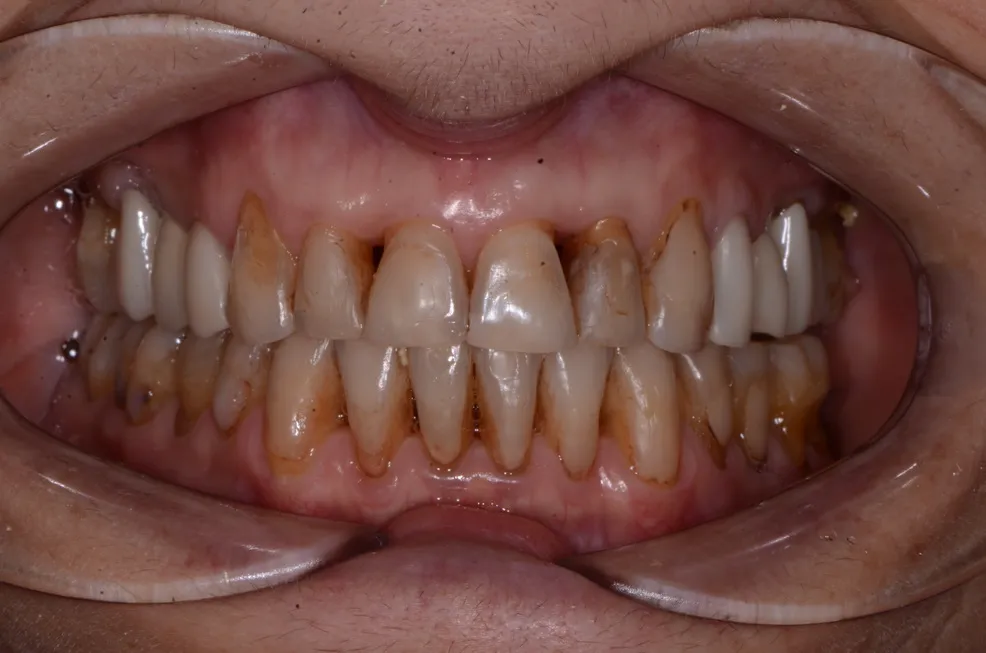 Porcelain Veneers and Bioclear Lower Front teeth: Before Closeup