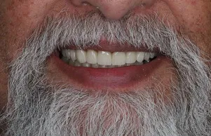 Porcelain Crowns: After