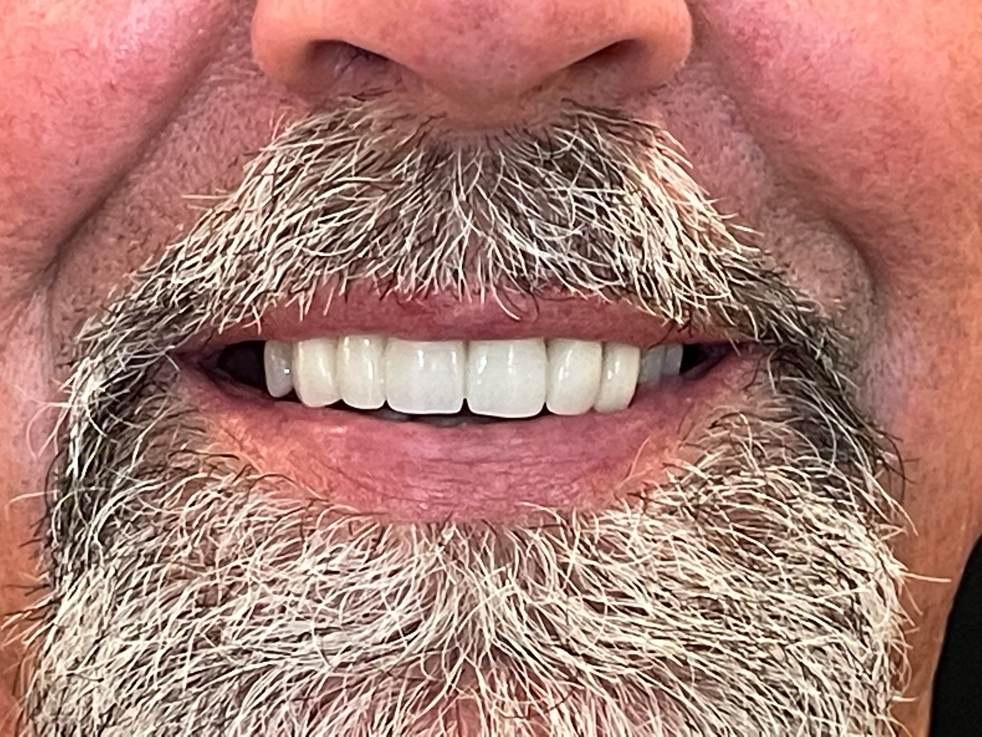 AOx Smile Treatment: Before 