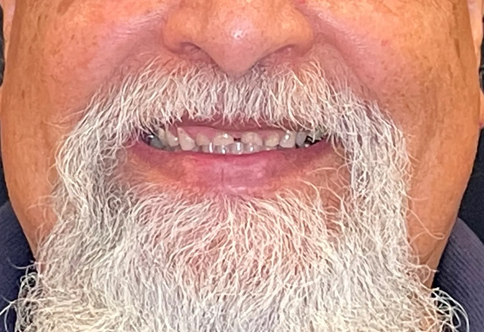 Porcelain Crowns: Before 
