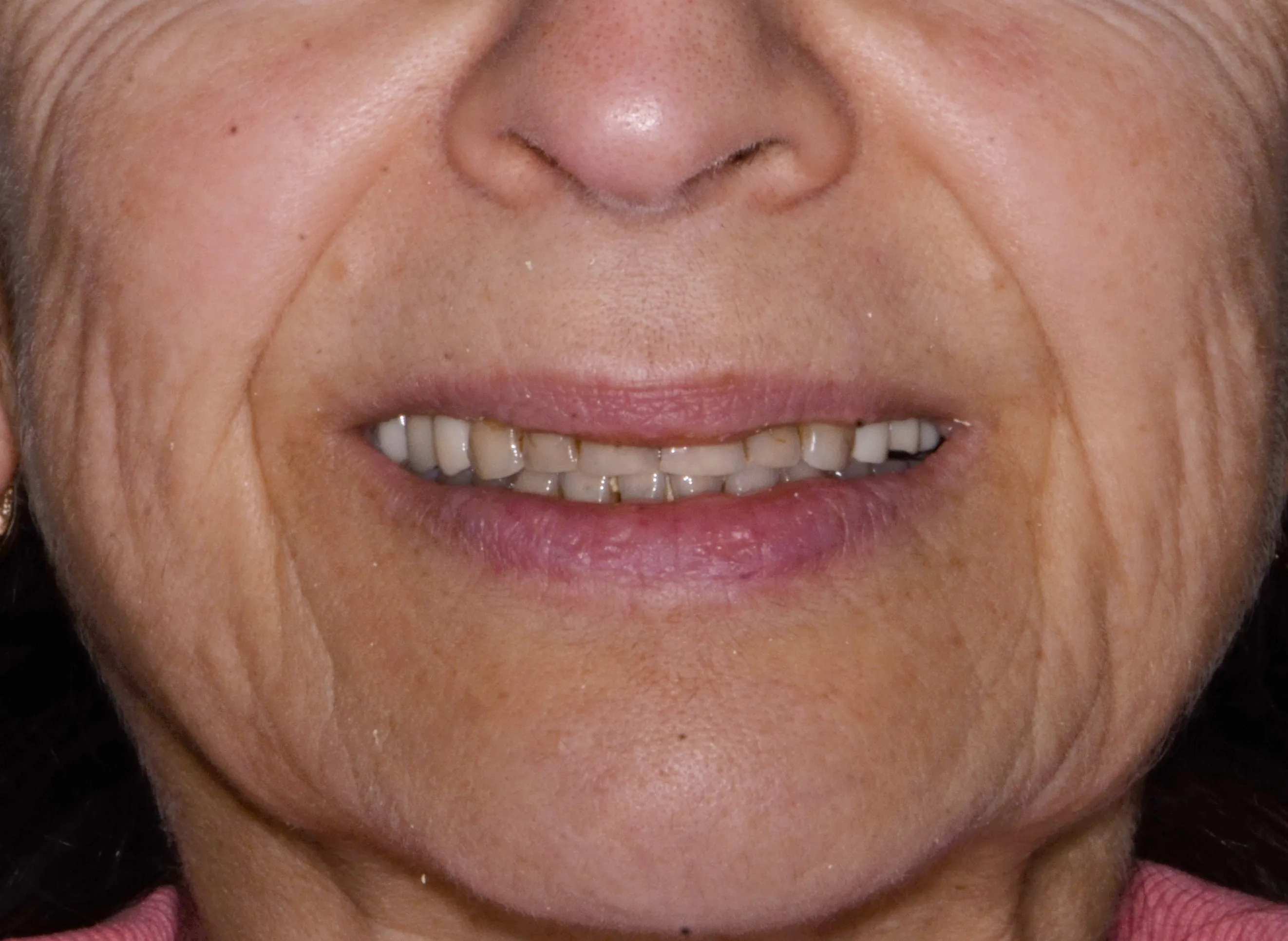 Porcelain Veneers and Bioclear Lower Front teeth: Before 